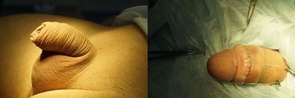 dương vật trước và sau khi phẫu thuật mở rộng