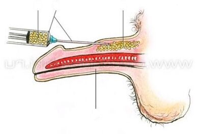 tiêm tăng kích thước dương vật