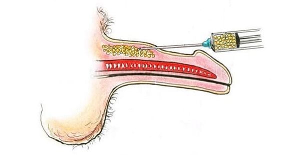 cấy ghép mô cơ để tăng kích thước dương vật