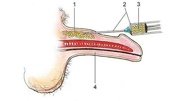 tiêm axit hyaluronic để làm dày dương vật
