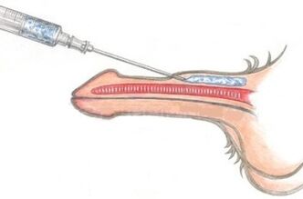 Phương pháp làm to dương vật nguy hiểm bằng cách tiêm Vaseline